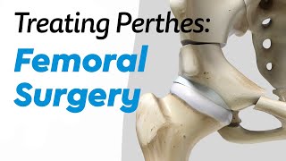 Femoral Surgery for Treating Perthes Disease in Children [upl. by Kussell302]