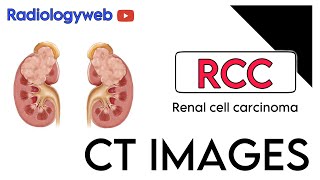 RENAL CELL CARCINOMA [upl. by Cleodal165]