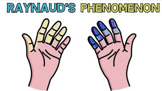 RAYNAUDS SYNDROME  CAUSE APPEARANCE DIAGNOSIS AND TREATMENT  RAYNAUDS PHENOMENON [upl. by Cupo]