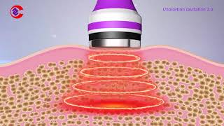 How Ultrasonic Cavitation Work How Ultrasonic Cavitation Remove Fat What Is Cavitation Machine [upl. by Goldfinch]