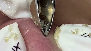 Nose Zone Precision Blackhead Extraction [upl. by Leiru]