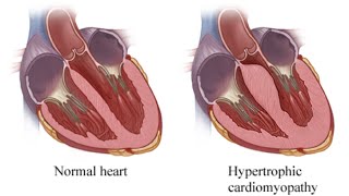 Hypertrophy Cardiomyopathy Idiopathic Hypertrophic Subaortic Stenosis [upl. by Sybila]