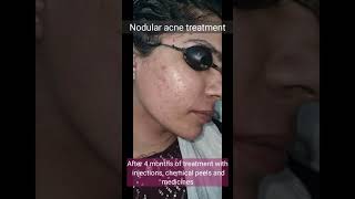 Nodular acne treatment  DrArif Iqbal  Before and After treatment [upl. by Nodyl]