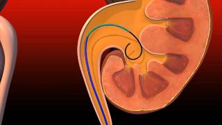 Ureteral Obstruction  Retrograde insertion of Resonance stent [upl. by Attaymik119]