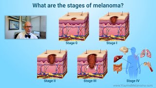 What are the stages of melanoma [upl. by Ahsaek]