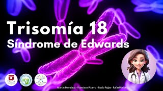 Trisomía 18 ‐ Síndrome de Edwards [upl. by Frazier]