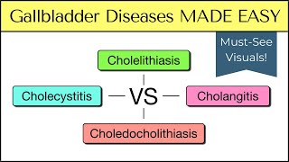 Cholecystitis vs Cholelithiasis vs Cholangitis vs Choledocholithiasis Nursing USMLE [upl. by Nosimaj]