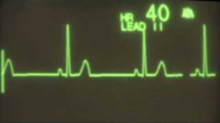 Sinus Bradycardia  ECG Training [upl. by Crutcher10]