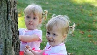 Conjoined Twins Learn to Live Apart [upl. by Ballman]