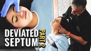 Years of difficulty breathing alleviated Deviated Septum Adjustment Part 2 DrRahim [upl. by Enilegnave]