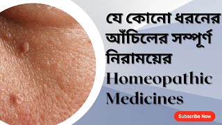 WARTS  আঁচিল এর সম্পূর্ণ নিরাময়ের জন্য HOMEOPATHIC MEDICINES [upl. by Cece]