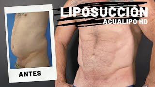 LIPOSUCCIÓN ABDOMEN Y FLANCOS EN HOMBRE MADURO CON DEFINICIÓN [upl. by Norford]