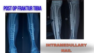 Post Operasi Fraktur Tibia Intramedullary Nail [upl. by Valentine]