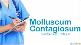 Molluscum Contagiosum ¦ Treatment and Symptoms [upl. by Sinnaiy]