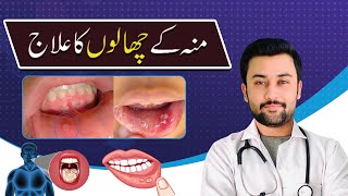 How to treat mouth ulcers and there causes [upl. by Haimerej]