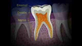 Pulpectomy to Save Nerve Damaged Tooth  Lake Merritt Dental Oakland CA [upl. by Ranita]