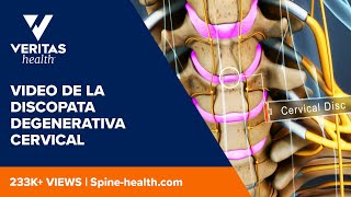 Video de la discopata degenerativa cervical [upl. by Kunin]