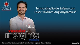 Caso 4 Termoablação de Safena com Laser de 1470nm Angiodynamics [upl. by Rafaj]