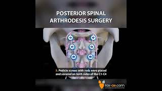 Posterior Spinal Arthrodesis Surgery [upl. by Aseyt513]