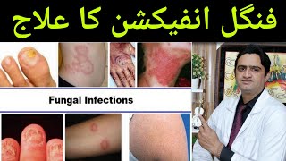 Fungal Infection Treatment  Fungal Infection Ka ilaj  Fungus Ka ilaj in Urdu  Dr umair ishaq [upl. by Asilad]