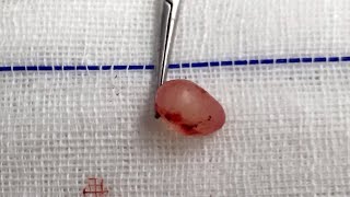 Epididymal Cyst [upl. by Ocko]