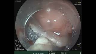 Endoscopic Submucosal Dissection in the rectum [upl. by Absa]