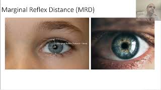 Ptosis Examination Clinical Skills in Ophthalmology [upl. by Moazami769]