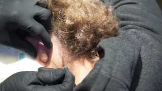 Popping large cyst behind ear [upl. by Walt412]