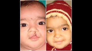 Smiling Pictures of Cleft Lip Children  Before amp After Surgery Pictures Dr Jaideep Singh Chauhan [upl. by Hylan]