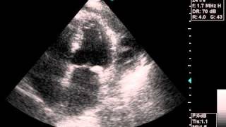 echocardiography pericardial effusionavi [upl. by Rees]