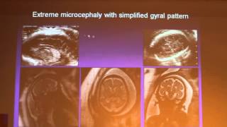 Prenatal MRI In The Diagnosis Of Malformations Of Cortical Development  Liat BEN SIRA Part 1 [upl. by Hiltan]