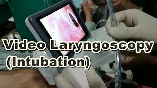 Video Laryngoscopy  Endotracheal Intubation  Laryngoscopy  General Anesthesia  Bougie Wire [upl. by Anizor]