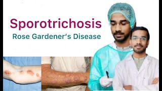 Sporotrichosis  Rose Gardeners Disease  Subcutaneous Mycosis [upl. by Eiralav119]