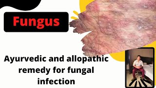 आयुर्वेदिक एंड एलोपैथिक रेमेडीज फॉर फंगल इनफेक्शन ayurvedic and allopathic remedy for fungal infecti [upl. by Ailegra638]