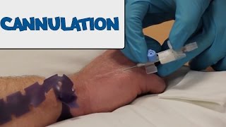 How to Perform Cannulation  OSCE Guide old version  UKMLA  CPSA [upl. by Ahsimac240]