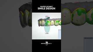 How To Design Fashionable Pop On Veneers veneers [upl. by Oimetra842]