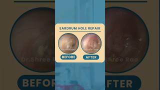 Ear drum hole repairDrShree raoDrRaosENThospitalmastoidectomytympanoplastyhearingrestoration [upl. by Esikram]