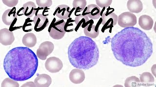 Acute Myeloid Leukemia AML w Monocytic Differentiation formerly AMML with Blasts amp Promonocytes [upl. by Yesmar326]