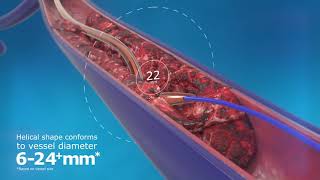 ClotHunter™ paired with ZelanteDVT™ Thrombectomy Catheter Enhancement [upl. by Gnouhk]