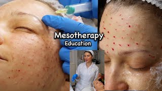 Mesotherapy for Face including around the Eyes injection technique using 13mm 30G needle [upl. by Crifasi]