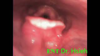 Right epiglottic cyst from nasopharyngeal scope 01 [upl. by Anaxor]