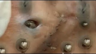 Acne treatment Blackhead remove with Spa Loan [upl. by Yadroc]