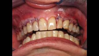 ★ Gingivitis Gel  Learn How I Cured My Gingivitus Permanently Without Surgery [upl. by Silvester]