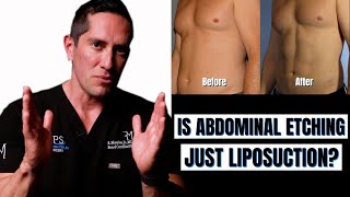 How is Ab Etching different than Liposuction [upl. by Bushore]