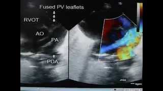 Pulmonar Atresia [upl. by Bannasch]