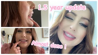 BRACES 15 years  Big OverbiteOverjet Correction [upl. by Annohsat]