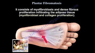 Plantar Fibromatosis  Everything You Need To Know  Dr Nabil Ebraheim [upl. by Isleen]