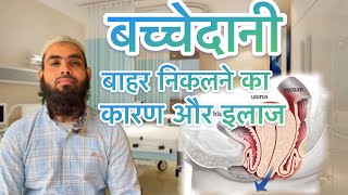 बच्चेदानी के खिसक आने का कारण और उसका इलाज ।what is uterus prolapse amp its exercisePelvic floor इलाज [upl. by Arica754]