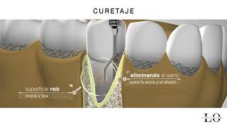 Periodoncia en Logroño raspado o curetaje [upl. by Eneleahs]