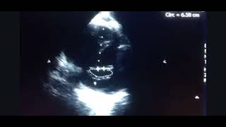 Mild MS diastolic doming hockeystick shape amp secondary prolapse of AMVL severe MR moderate AR [upl. by Mariken400]